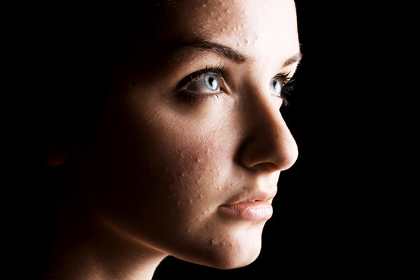 Overcome congested and acne-prone skin